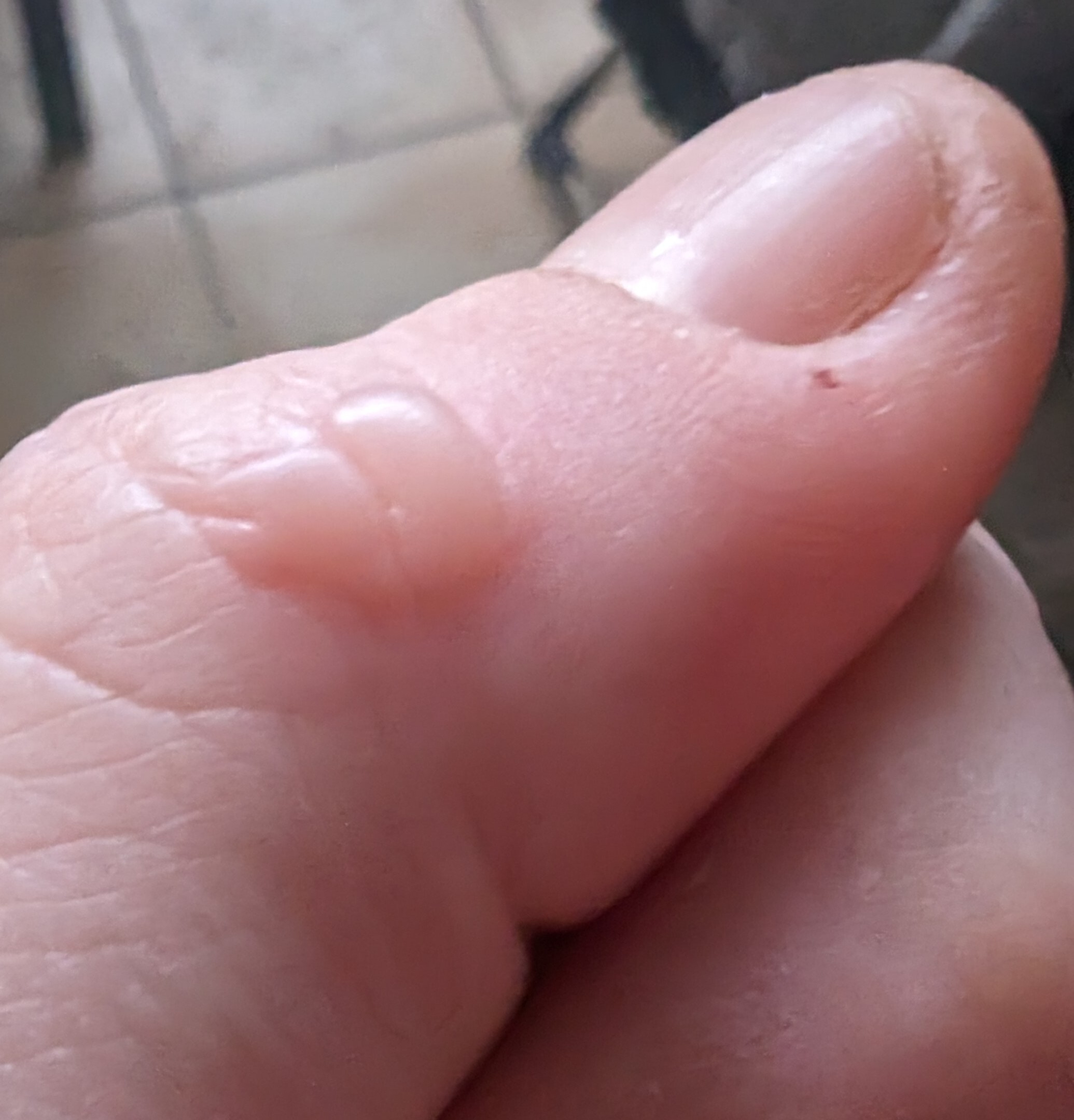 thumb with a blister on knuckle